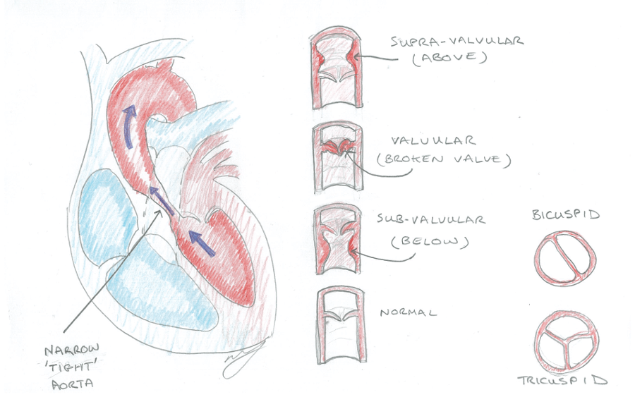 Aortic Stenosis (AS)