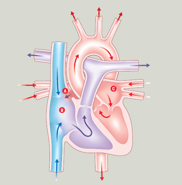 Atrial Septal Defect (ASD)