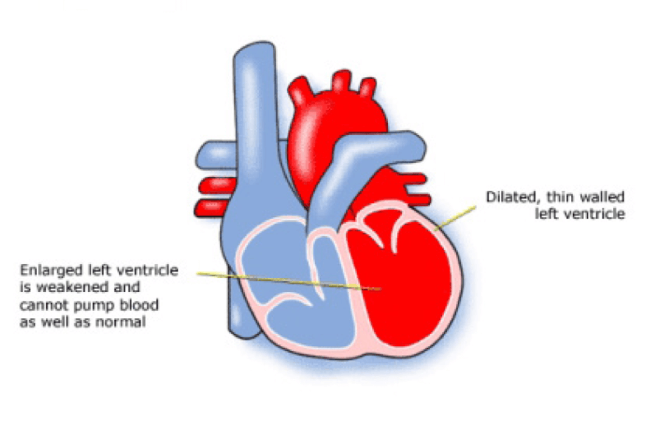 Dilated Cardiomyopathy