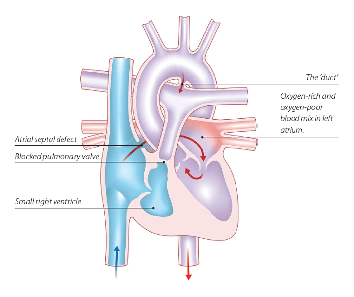 Pulmonary Atresia with Intact Venticular Septum