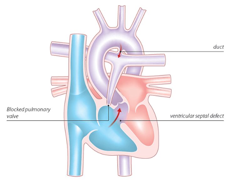 Pulmonary Atresia with Venticular Septal Defect