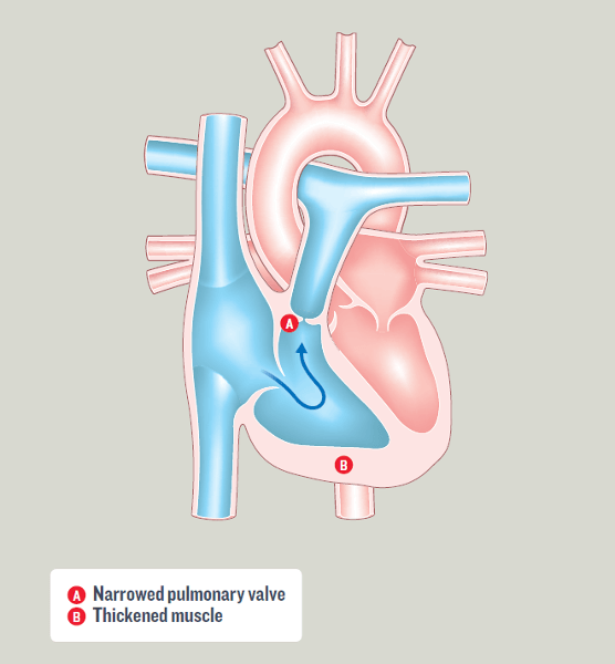 Pulmonary Stenosis (PS)