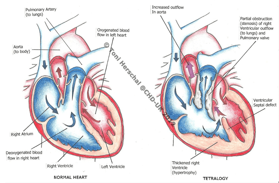 Tetralogy of Fallot (TOF)