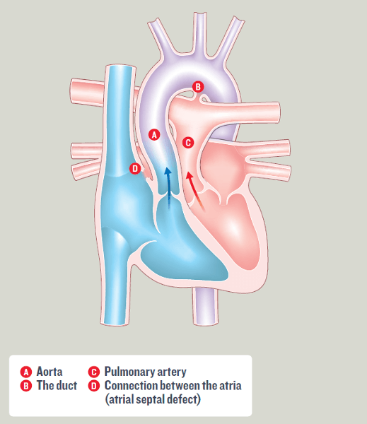 Transposition of the Great Arteries (TGA)